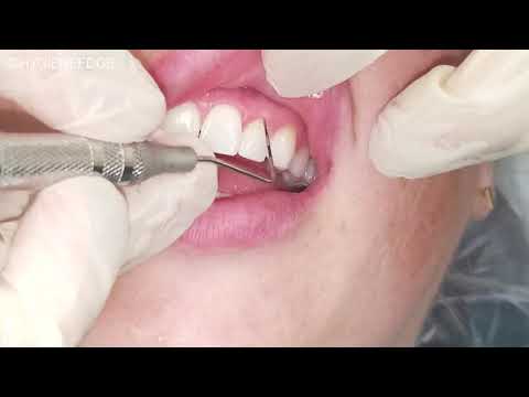 Understanding Dental and Periodontal Charting for Better Care