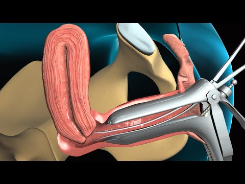 Understanding Endometrial Biopsy: What to Expect and Why post thumbnail image