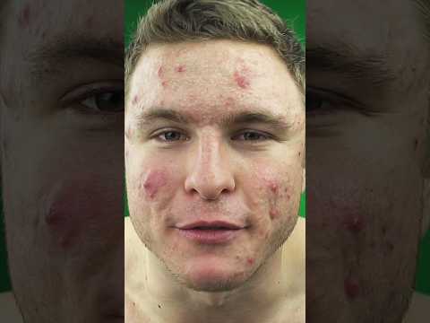 Does Creatine Lead to Acne? Insights from Recent Research