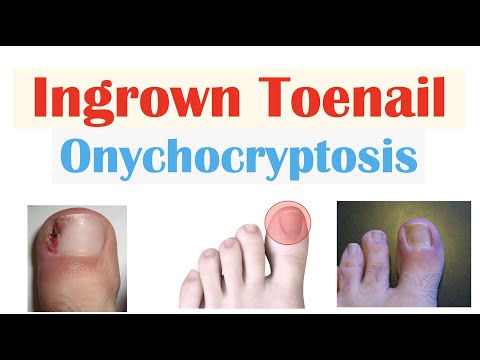 Understanding Ingrown Nails: Symptoms, Care, and Solutions