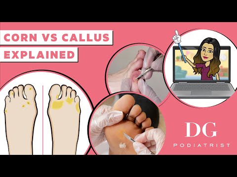 Understanding Foot Corns: Symptoms and Causes Explained