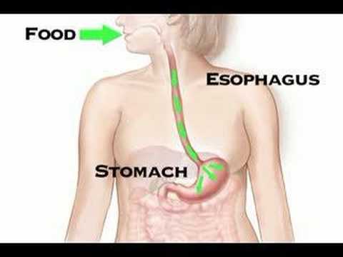 Understanding Acid Reflux: Symptoms, Causes, and Tests