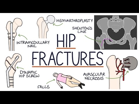 Hemiarthroplasty: Understanding Procedure, Recovery, and Risks