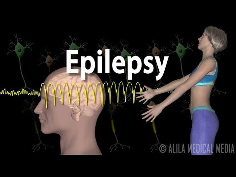 Recognizing Seizure Types and Their Distinct Symptoms