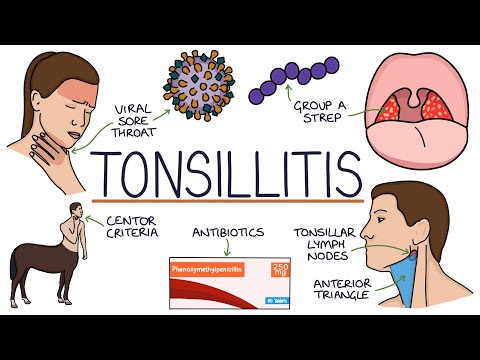 Understanding Chronic Tonsillitis: Key Causes and Symptoms post thumbnail image