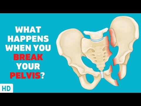 Understanding the Impact of a Broken Pelvis on Your Health