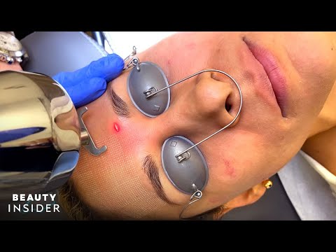 Effective Treatments for Removing Pimple Scars Safely