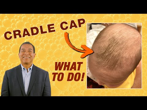 Effective Strategies to Prevent Cradle Cap in Infants post thumbnail image