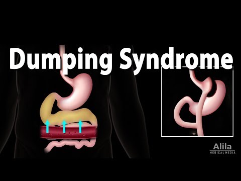 Understanding Dumping Syndrome: Symptoms, Causes, and Care