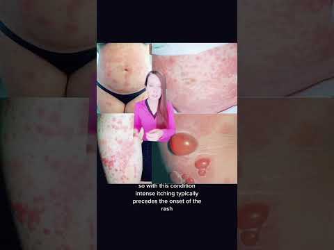 Understanding Pemphigoid Gestationis: Symptoms and Care During Pregnancy