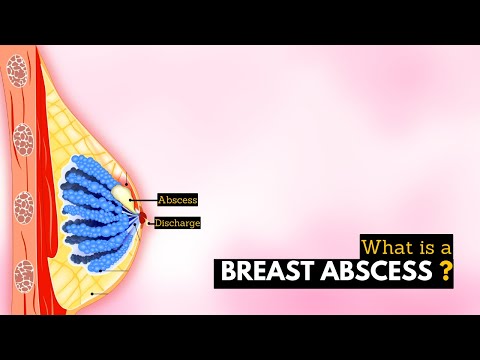 Understanding Breast Abscess: Causes, Symptoms, and Care