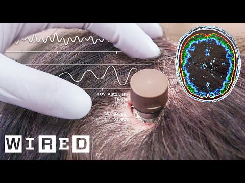 Understanding Skepticism Around Elon Musk's Brain Implants
