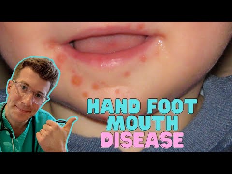 Coxsackievirus Infections: Symptoms and Causes Explained