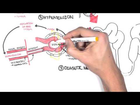 Understanding Kidney Failure: Causes, Types, and Symptoms