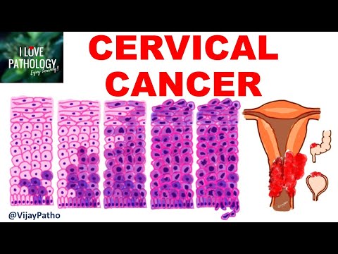 Understanding Squamous Epithelial Cells and Cancer Risks