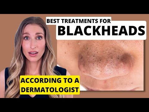 Banish Blackheads: What Causes Them and How to Treat Them post thumbnail image