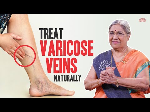 Effective Home Treatments for Managing Varicose Veins post thumbnail image