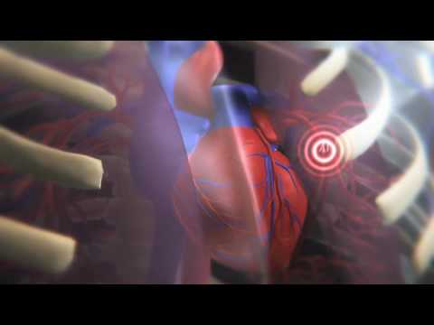 When Does a Pulmonary Embolism Become Life-Threatening?