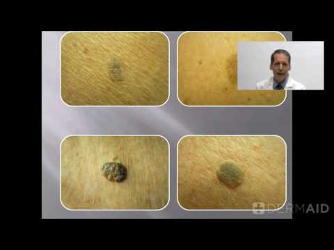 Understanding Seborrheic Keratosis: Symptoms and Treatment Options