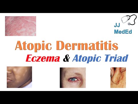 Understanding Eczema Triggers and Atopic Dermatitis Risks