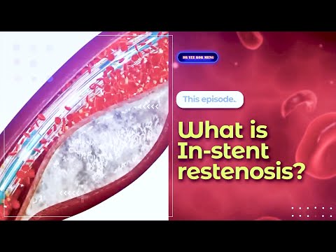 Understanding Restenosis After Angioplasty and Stenting