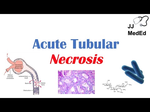 Understanding Acute Kidney Tubular Necrosis: Key Symptoms & Causes