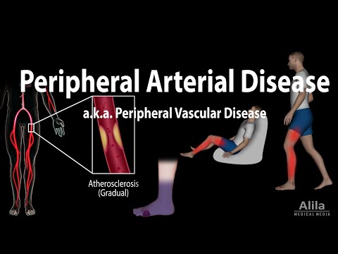 Understanding How Peripheral Artery Disease Affects Sleep