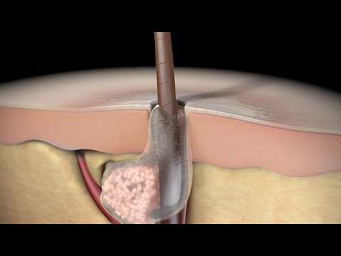 Understanding Severe Acne Symptoms and Effective Treatments