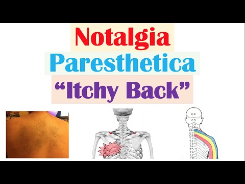 Understanding Notalgia Paresthetica: Symptoms and Relief