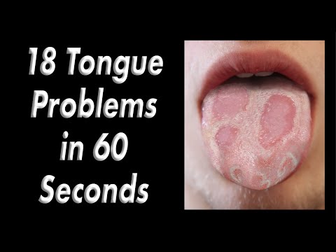 Understanding Tongue Problems: Symptoms and Diagnosis Explained