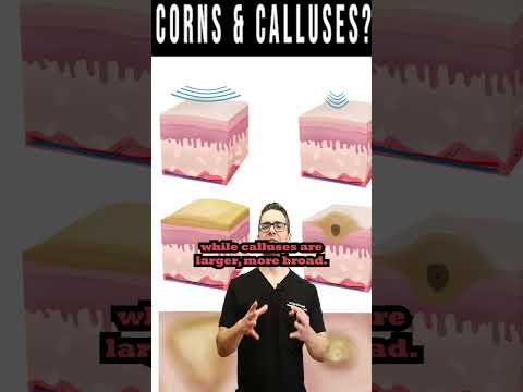 Relief from Corns and Calluses: Symptoms and Solutions post thumbnail image