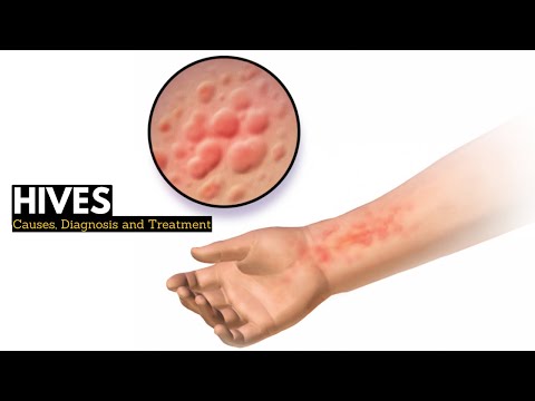 Understanding Hives: Causes, Risks, Prevention, and Images