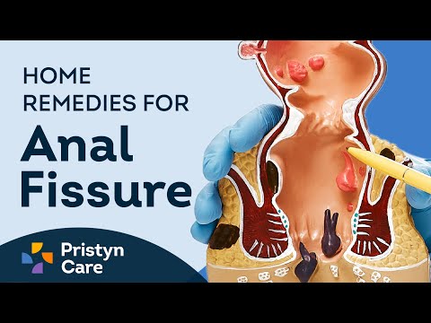 Soothing Solutions: Home Remedies for Anal Fissures post thumbnail image
