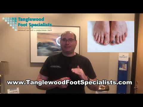 What to Know About Runner's Toe Symptoms and Treatment
