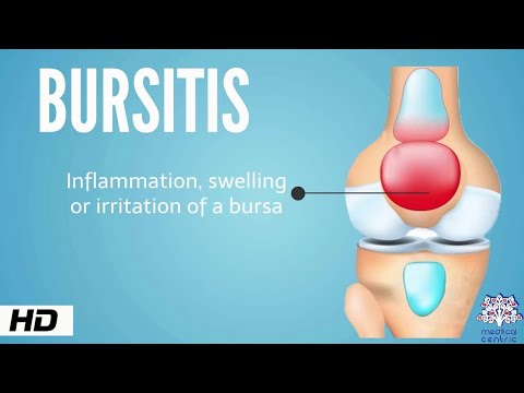 Understanding Bursitis: Symptoms, Care, and Treatment Options
