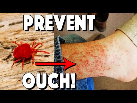 Stop the Itch: Prevent and Treat Chigger Bites Effectively