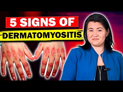 Identifying Heliotrope Rash and Dermatomyositis Symptoms