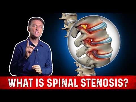 Understanding Spinal Stenosis and Its Impact on Your Health