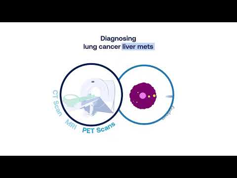 Understanding Metastatic Adenocarcinoma: Symptoms and Causes