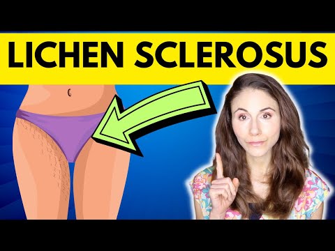 Understanding Lichen Sclerosus: Symptoms and Treatment Options