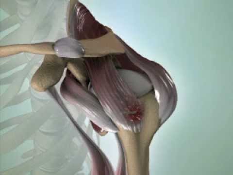 Relieving Rotator Cuff Pain: Symptoms, Causes, and Care post thumbnail image