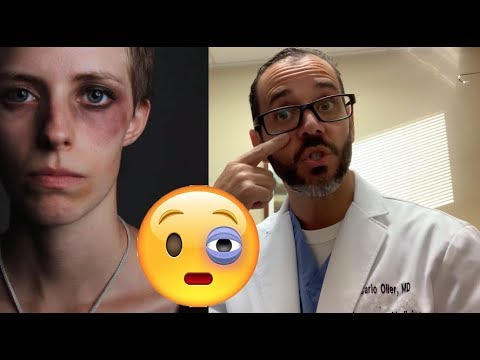 Understanding Black Eyes: Causes and How to Heal Them