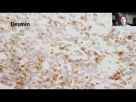 Rhabdomyosarcoma: Essential Insights and Facts