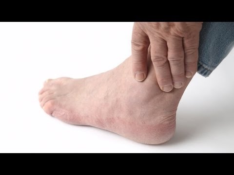 Recognizing Gout: Key Signs, Symptoms, and Complications