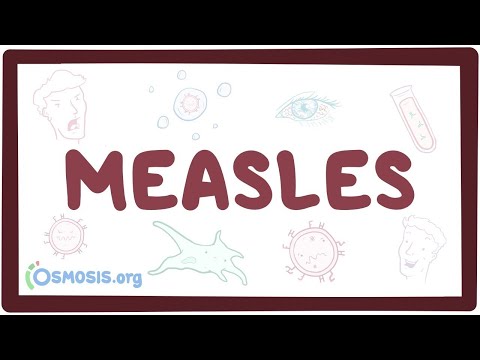 Measles Uncovered: Symptoms, Diagnosis, and Treatment Options