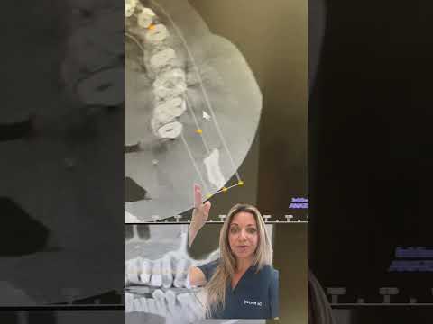 Understanding Sinus Lift: Procedure, Cost, and Recovery Insights