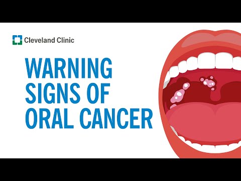 Recognizing Oral Cancer: Key Signs and Symptoms to Watch For post thumbnail image