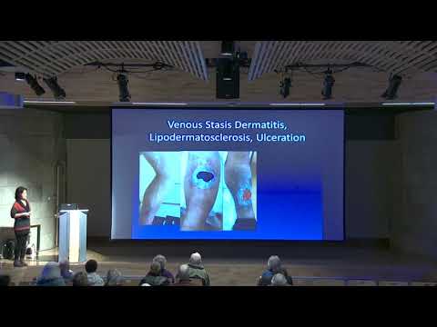 Say Goodbye to Varicose and Spider Veins: Symptoms and Care