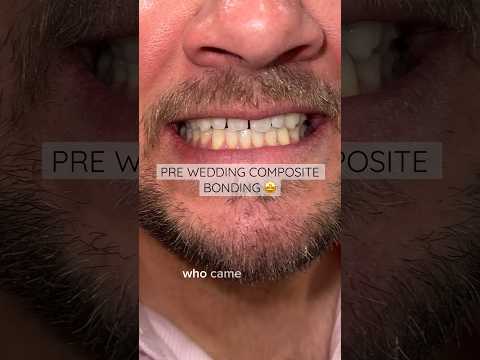 Teeth Fillers for Gaps: Treatment Options for a Confident Smile