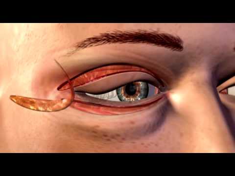 Transform Your Look: Double Eyelid Surgery and Alternatives